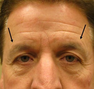 ptosis cejas