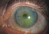 contact lens tera