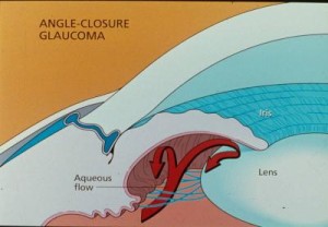 Qvision Glaucoma agudo de ángulo cerrado 20061104134914 glaucoma angulo cerrado1