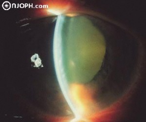 Qvision Glaucoma agudo de ángulo cerrado Glaucoma agudo11