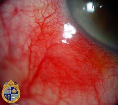 Qvision Epiescleritis epiescleritis