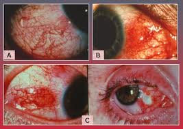 Qvision Epiescleritis epiescleritis2