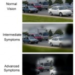 Qvision Glaucoma de tensión normal Campo visual reducido