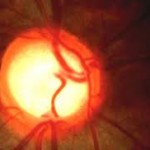 Qvision Glaucoma de tensión normal Excavacion papilar1