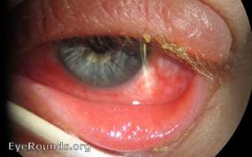 Qvision Conjuntivitis virales Conjuntivitis adenovirica