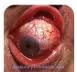 Qvision Conjuntivitis virales Conjuntivitis epidemica2