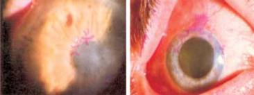 Qvision Conjuntivitis virales Conjuntivitis herpetica