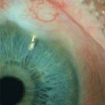 Qvision ¿Es la marihuana un tratamiento efectivo para el glaucoma? express