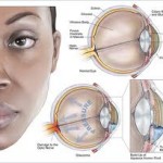 Qvision Capacidad de lectura y glaucoma Glaucoma1