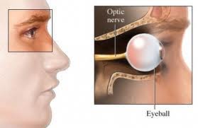 Qvision Neuritis óptica Papilitis consiste