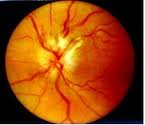 Qvision Neuritis óptica Papilitis