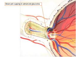 Qvision La corbata ajustada nuevo factor de riesgo en glaucoma Papila