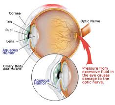 Qvision El consumo de cocaina factor de riesgo para el glaucoma glau11