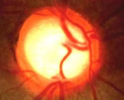 Qvision El consumo de cocaina factor de riesgo para el glaucoma glau21