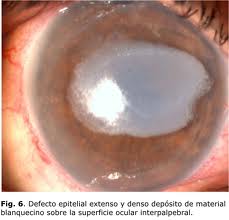 Qvision El suero autólogo como tratamiento de la patología de superficie ocular Ulcera