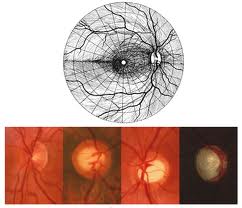 Qvision Grandes dosis de calcio y de hierro pueden aumentar el riesgo de glaucoma glaucoma papila