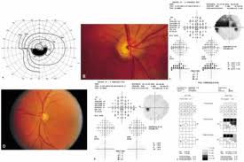 Qvision Rayos X pueden proteger contra el glaucoma CV