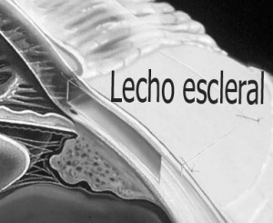 Qvision Glaucoma: Posibilidades futuras del Femtosegundo Lecho escleral