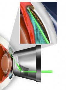 Qvision Micropulse: Nuevo tratamiento para glaucoma trabeloculoplastia