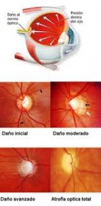 Qvision Alteraciones en el intercambio de LCR en el nervio óptico en el glaucoma de tensión normal glauc
