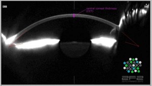 Qvision Propiedades biomecanicas de la cornea en el glaucoma central corneal thickness1