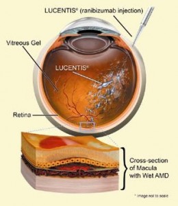 Qvision Aumento de presión intraocular tras inyección intravítrea de antiangiogénicos inyeccion1