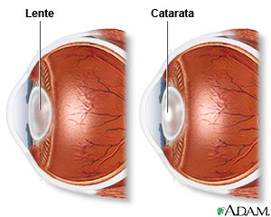 Qvision Reducción de presión intraocular después de extracción de catarata la foto 1