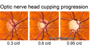 Qvision Reducción de presión intraocular después de extracción de catarata la foto