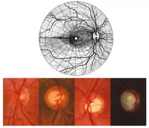Qvision Estudio asocia el café con cafeina al glaucoma papilas