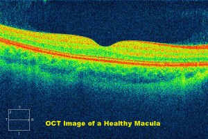 Qvision Correlación entre el grosor macular y el campo visual glaucomatoso Healthy macula