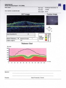 Qvision Correlación entre el grosor macular y el campo visual glaucomatoso MacularPucker preop OCT