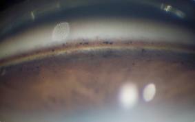 Glaucoma pigmentario