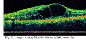 edema macular