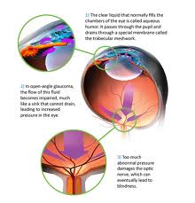 glaucoma1
