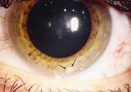 cornea