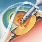 Glaucoma 
