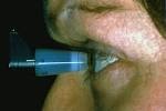 Glaucoma