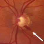 Glaucoma