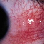 Glaucoma