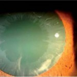 Glaucoma