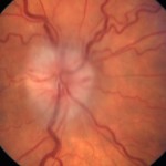 Glaucoma
