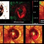 Glaucoma