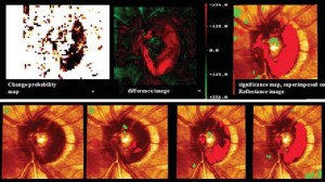 Glaucoma