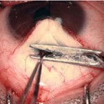 GLAUCOMA