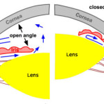 Glaucoma