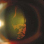 Glaucoma