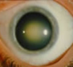 Glaucoma