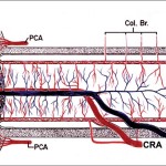 Glaucoma