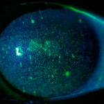 Glaucoma