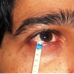 Glaucoma